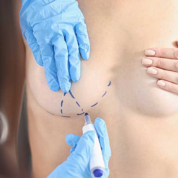 Lipofilling mammaire à Lille chez le dr Laurent