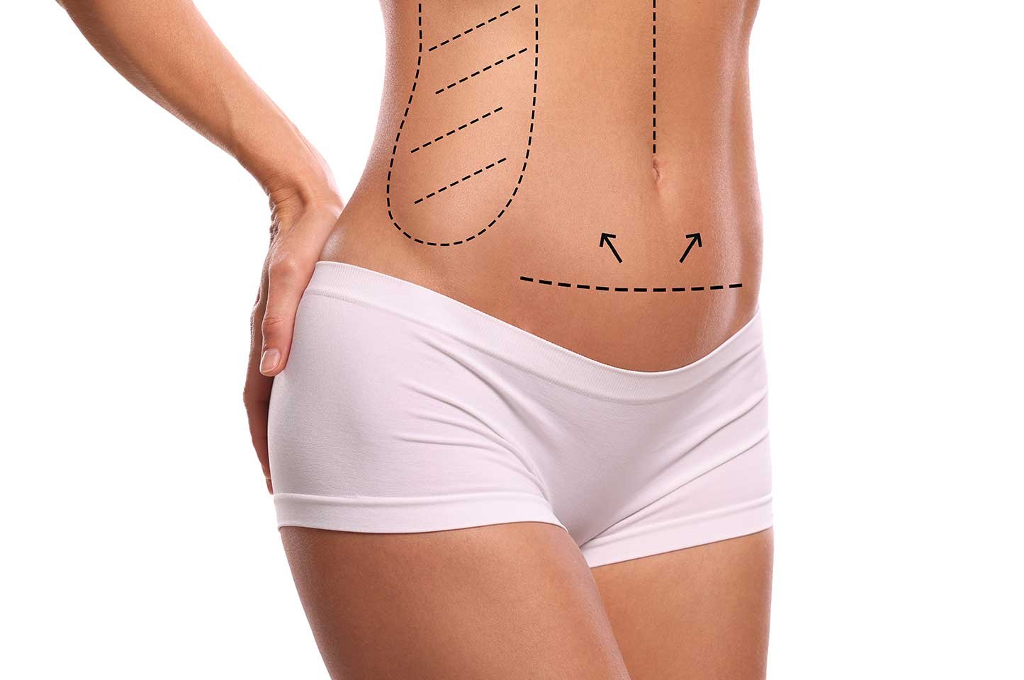 Abdominoplastie à Lille