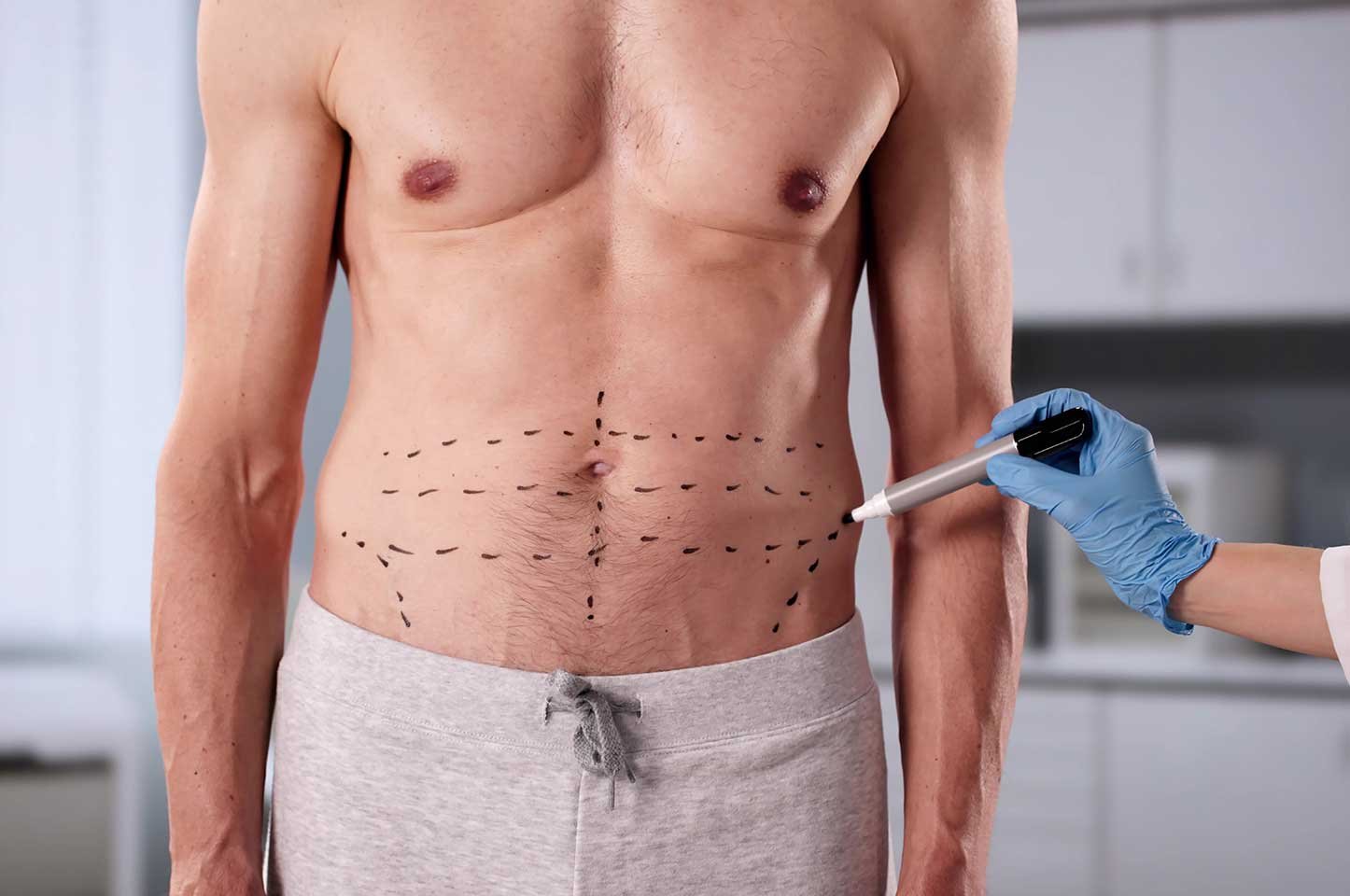 Lipoaspiration chez l’homme à Lille